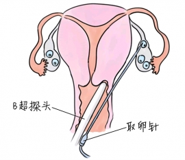 发烧对苏州捐卵宝宝的危害