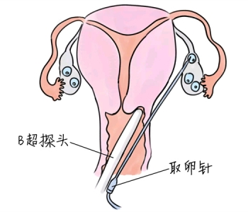 发烧对苏州捐卵宝宝的危害